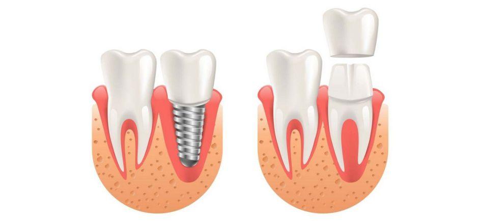 Коронка и имплант: в чем разница?
