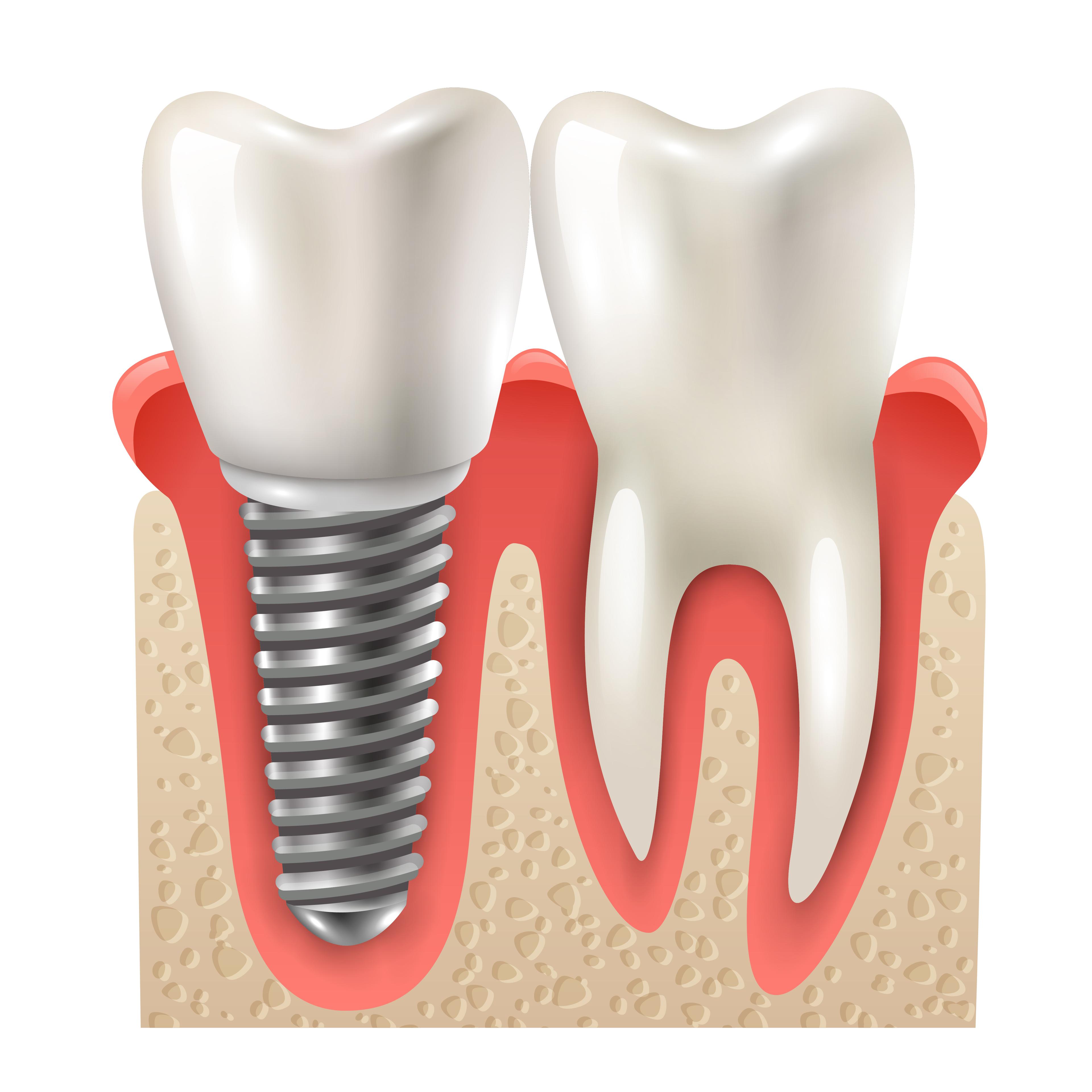 ЗУБНОЙ ИМПЛАНТ DENTIS