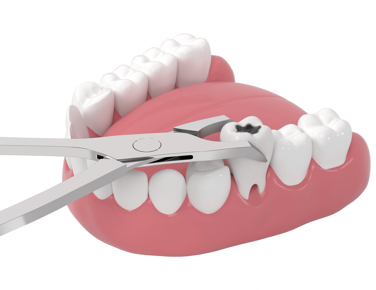 Как проходит процесс удаления зубов