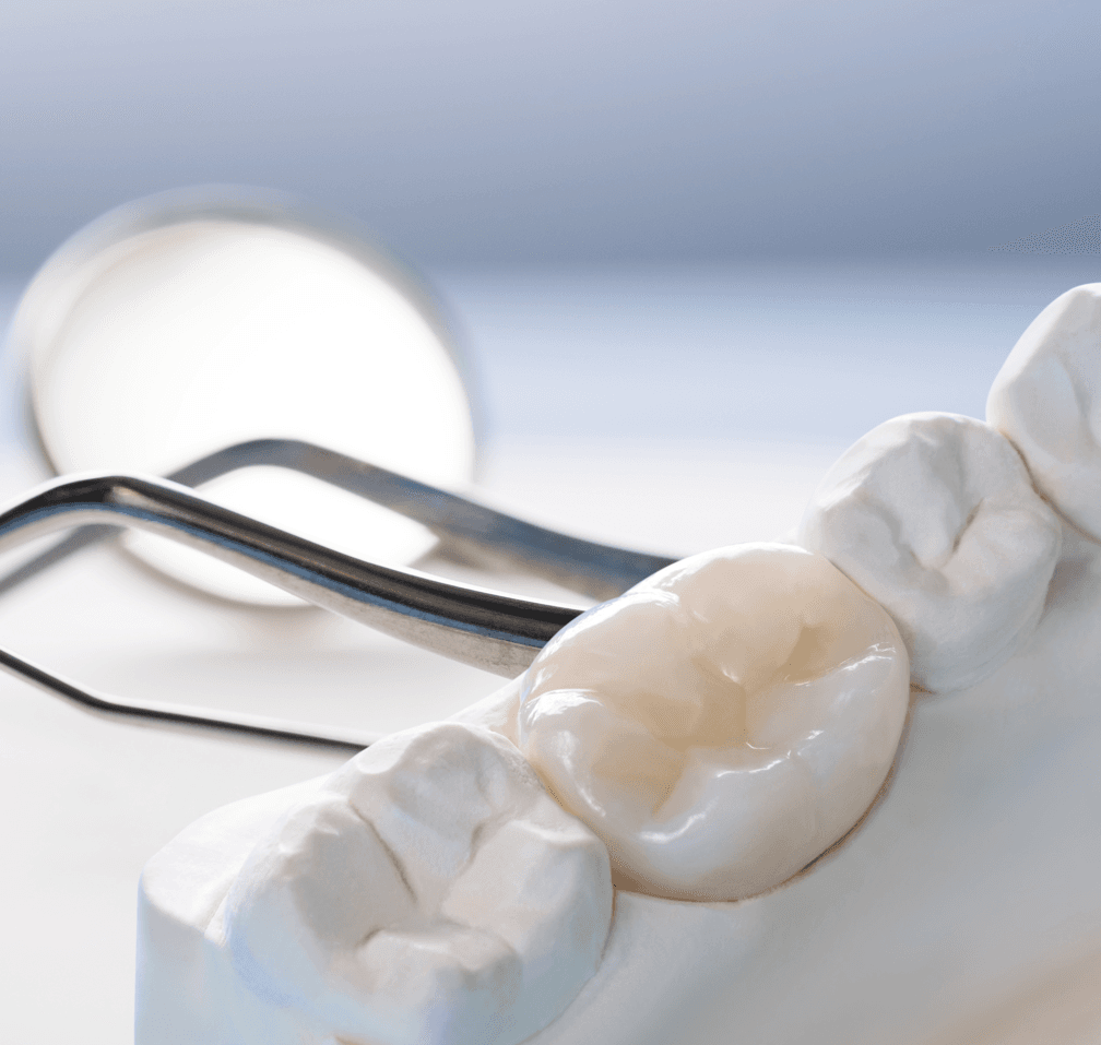 Когда стоматологи ставят на зубы коронки?